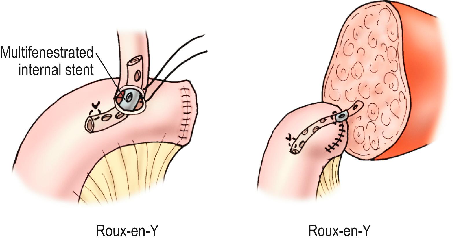 Fig. 45.5, Bile duct reconstruction is shown using the common hepatic duct in whole organ transplants (left) and segmental hepatic ducts into a Roux-en-Y intestinal limb for reduced-sized liver transplants (right). An internal multifenestrated stent is used in both situations.