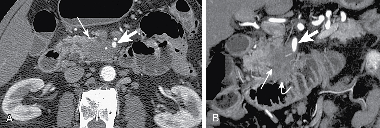 Fig. 13.1, Locally invasive pancreatic adenocarcinoma arising from the uncinate process on axial (A) and coronal (B) multidetector computed tomography images, manifesting as a hypodense mass ( thin arrow ), which circumscribes the superior mesenteric artery ( thick arrow ) for more than 180 degrees and invades the duodenum ( curved arrow , B), rendering the tumor inoperable.