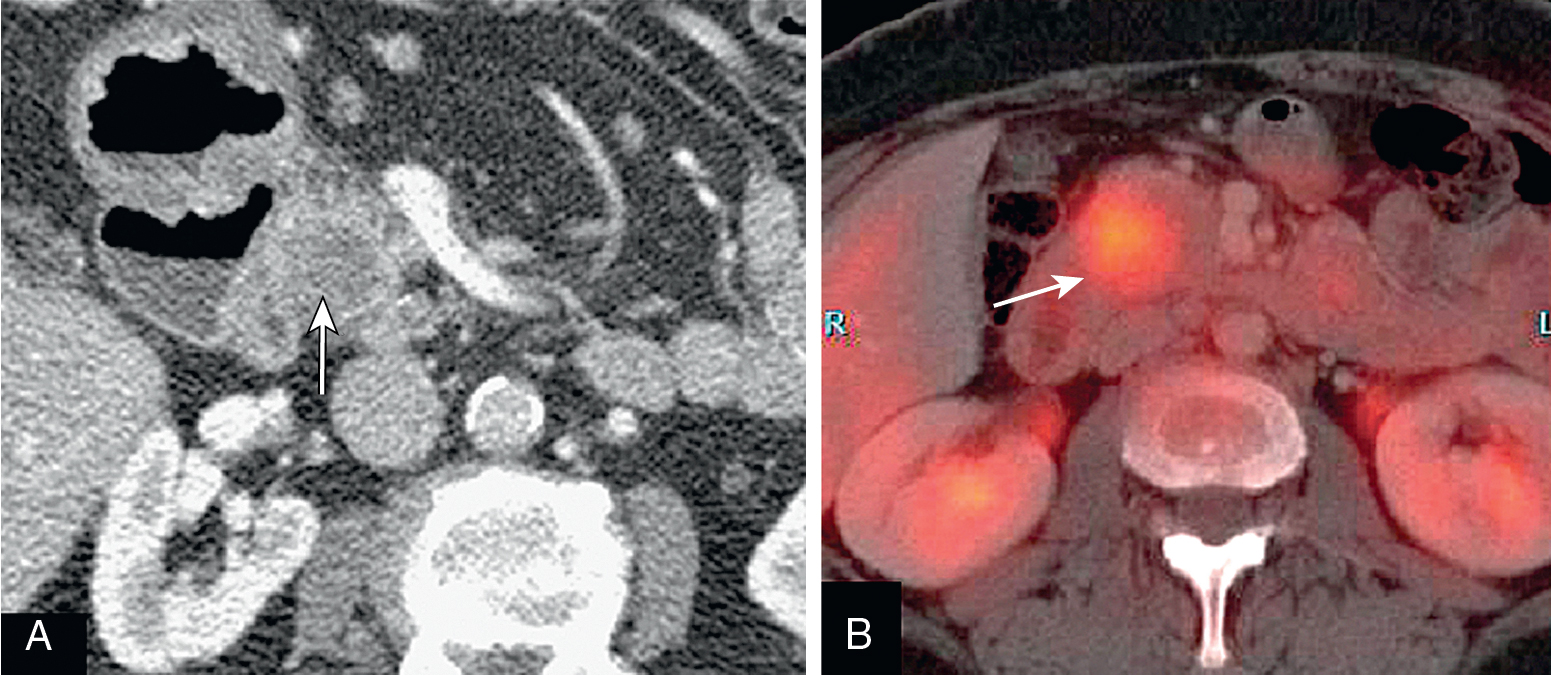 Fig. 13.11, Axial multidetector computed tomography (MDCT) (A) and fused positron emission tomography and MDCT (B) images show a pancreatic adenocarcinoma ( arrows ) that avidly takes up fluorodeoxyglucose, highlighting it against normal pancreatic parenchyma.