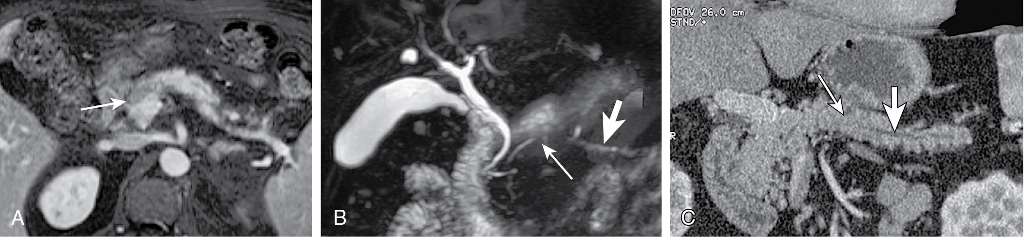 Fig. 13.12, Autoimmune mass-forming chronic pancreatitis manifests as smooth reduction in the main pancreatic duct over a long segment without any features of obstruction within the lesion ( thin arrow ) and absent upstream dilatation ( thick arrow ) in axial pancreatic phase, contrast enhanced T1-weighted (A) image, three-dimensional magnetic resonance cholangiopancreatography (B), and multidetector computed tomography pancreatogram (C).