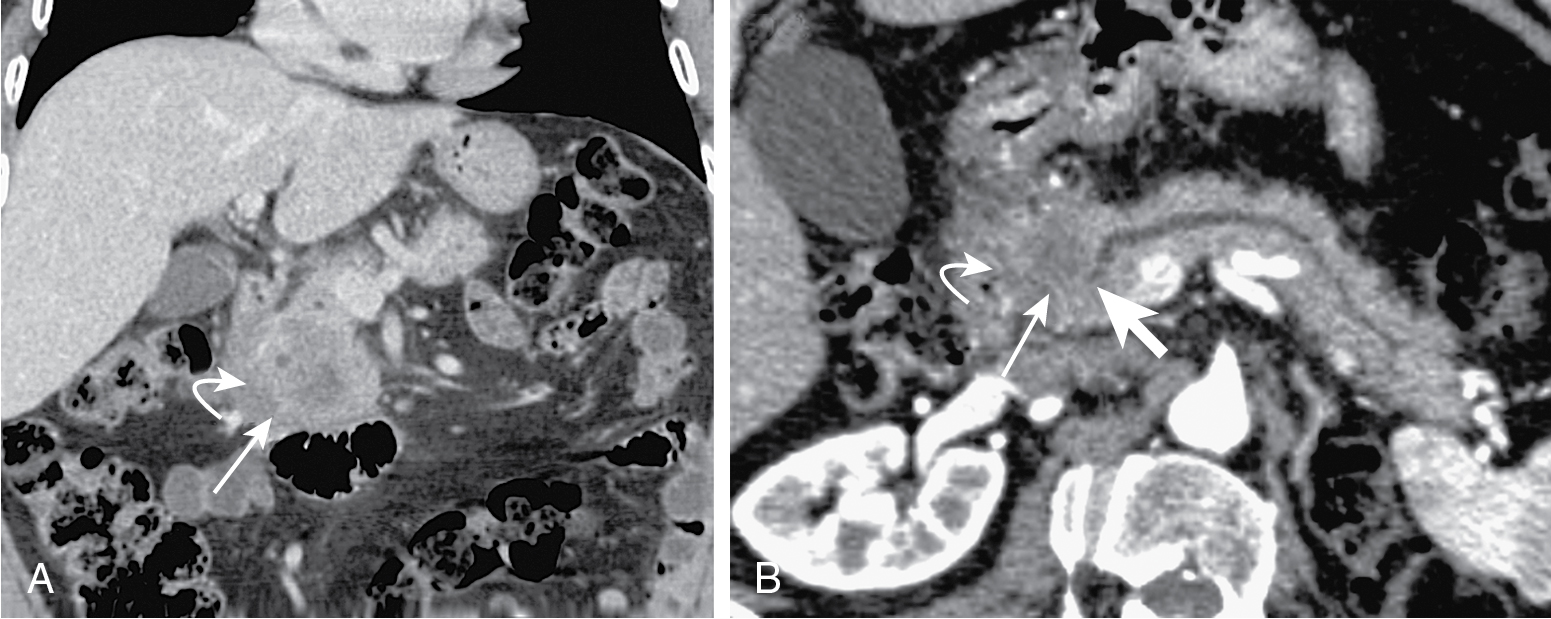 Fig. 13.2, Adenocarcinoma of the pancreas shown on coronal (A) and curved reconstructed (B) multidetector computed tomography images. Note a poorly enhancing mass ( thin arrow ) that obstructs the main pancreatic duct ( thick arrow ) and infiltrates the duodenum ( curved arrow ).