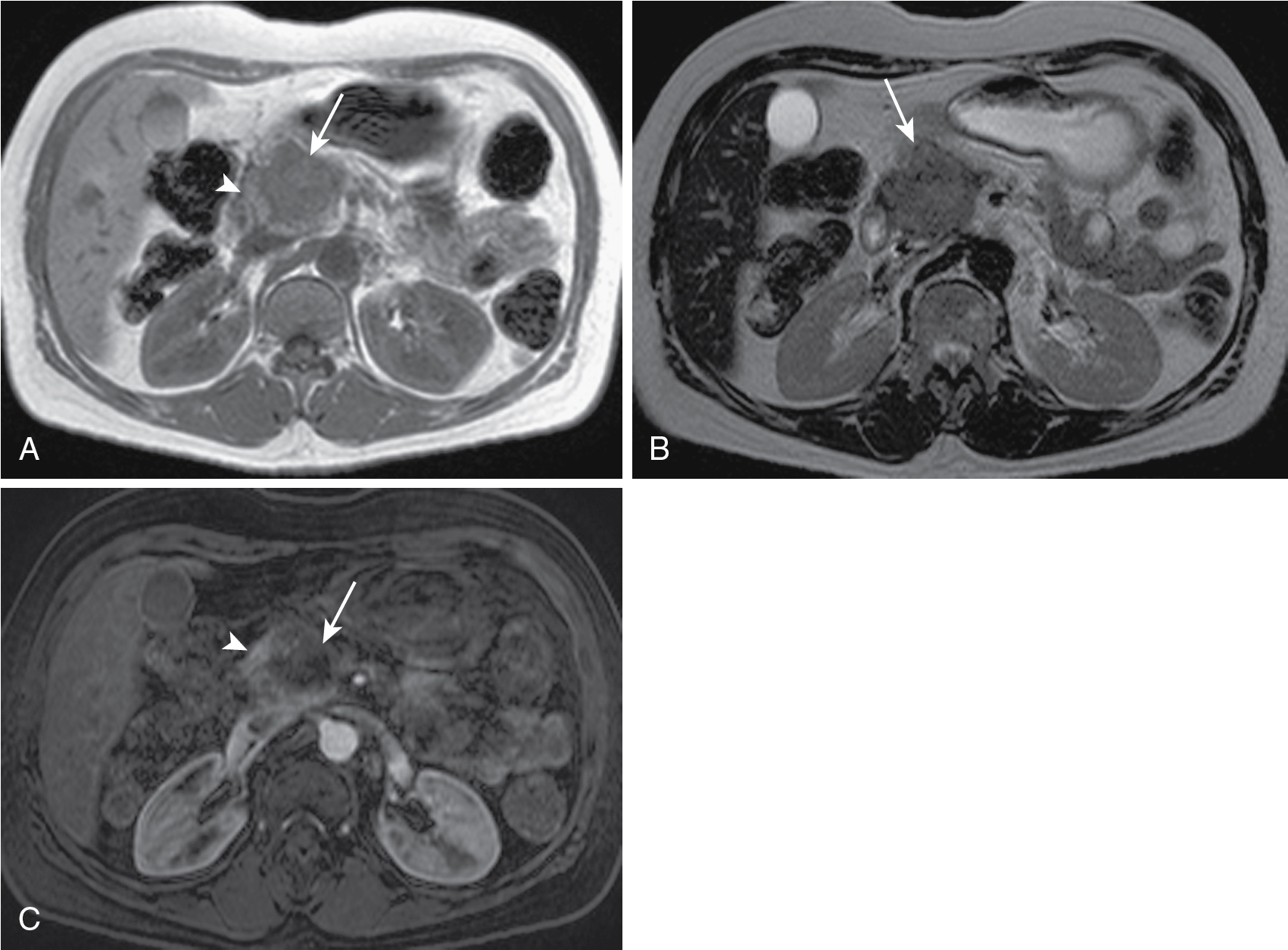 Fig. 13.3, Pancreatic adenocarcinoma. (A) The in-phase (T1-weighted) image in a patient with pancreatic adenocarcinoma in the pancreatic head ( arrow ) shows relative hypointensity compared with normal parenchyma ( arrowhead ). (B) The T2-weighted image exemplifies the usual hypointensity ( arrow ) with little contrast between normal tissue and neoplasm. (C) The enhanced image bears the highest tissue contrast between the lesion ( arrow ) and normal pancreatic tissue ( arrowhead ).