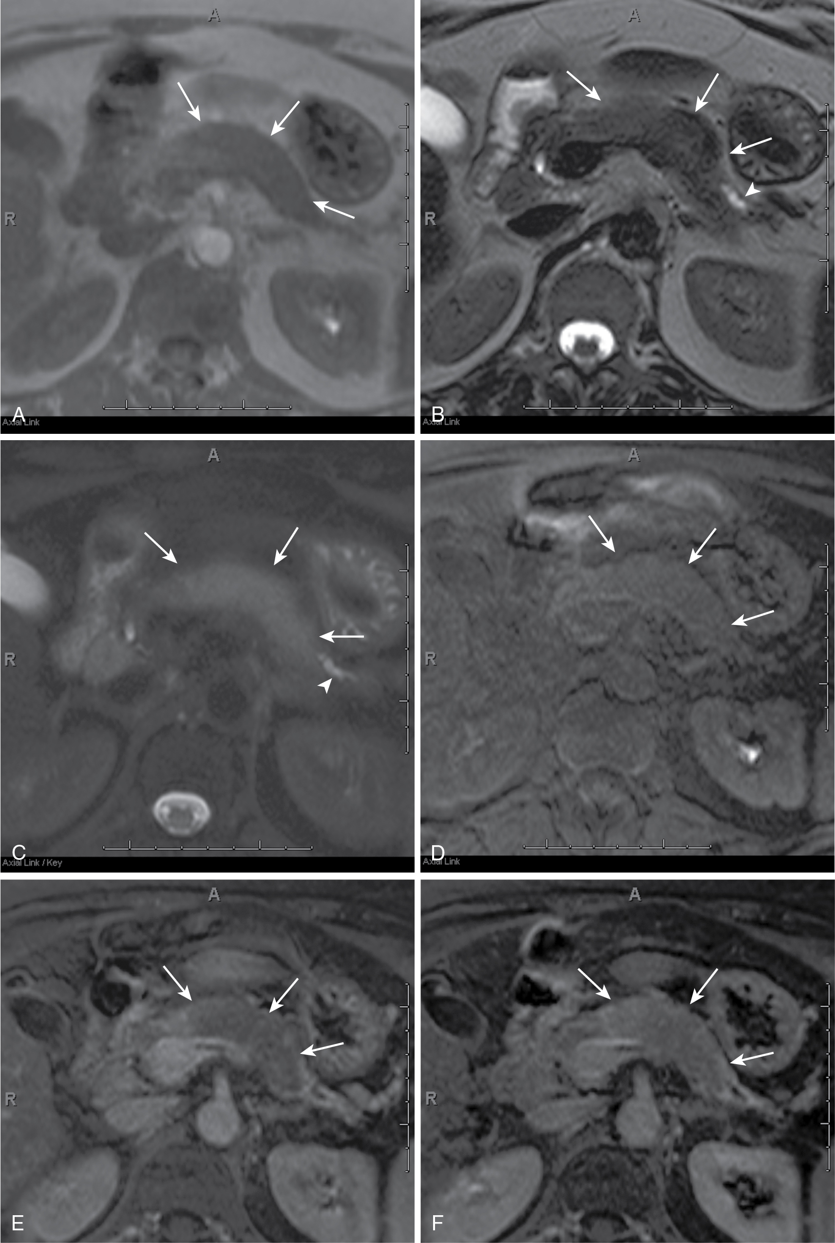 Fig. 13.4, Pancreatic adenocarcinoma—arterial phase imaging. Infiltrative mass enlarges the body of the pancreas ( arrows ), which can be seen in the in-phase T1-weighted (A) and the precontrast fat-suppressed T1-weighted gradient recalled-echo (D) images in contrast to the normal pancreatic parenchyma in the head of the pancreas. This mass demonstrates mildly increased signal intensity in T2-weighted (B) images, which is pronounced in fat-suppressed T2-weighted (C) images. In addition, distal gland atrophy and duct dilatation ( arrowheads ) can be seen in the T2-weighted (B) and fat-suppressed T2-weighted (C) images. Furthermore, this mass demonstrates decreased enhancement, compared with the normal pancreas, and is most pronounced in early arterial phase fat-suppressed T1-weighted gradient recalled-echo (E) imaging, with gradual enhancement in delayed phase, fat-suppressed T1-weighted gradient recalled-echo imaging (F) related to desmoplastic content.