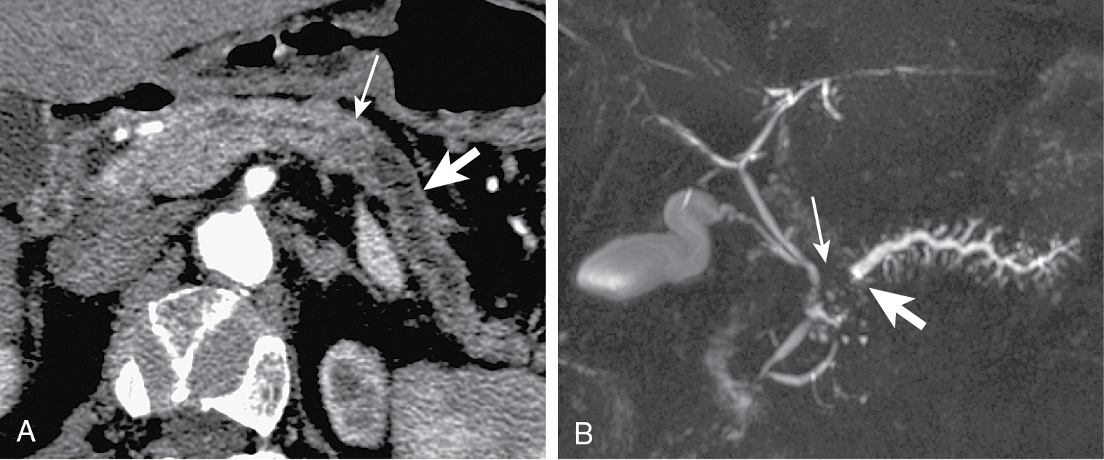 Fig. 13.5, Pancreatic adenocarcinoma in two different patients on multidetector computed tomography pancreatogram (A) and three dimensional magnetic resonance cholangiopancreatography (MRCP) (B) as a small and barely visible lesion ( thin arrow ) causing abrupt narrowing of the main pancreatic duct and upstream dilatation ( thick arrow ). The main pancreatic duct dilatation is better evaluated on MRCP images.