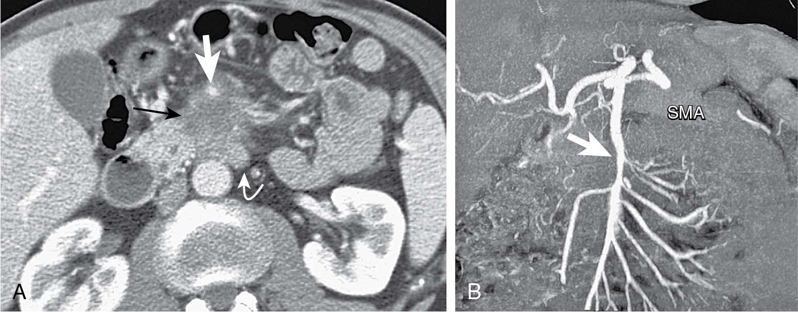 Fig. 13.6, Axial (A) and coronal maximum intensity projection (B) multidetector computed tomography images show an advanced adenocarcinoma ( thin arrow ) infiltrating the superior mesenteric artery ( SMA, thick arrow ) that appears as the “tear drop” sign. Lymph node metastases are present ( curved arrow ).