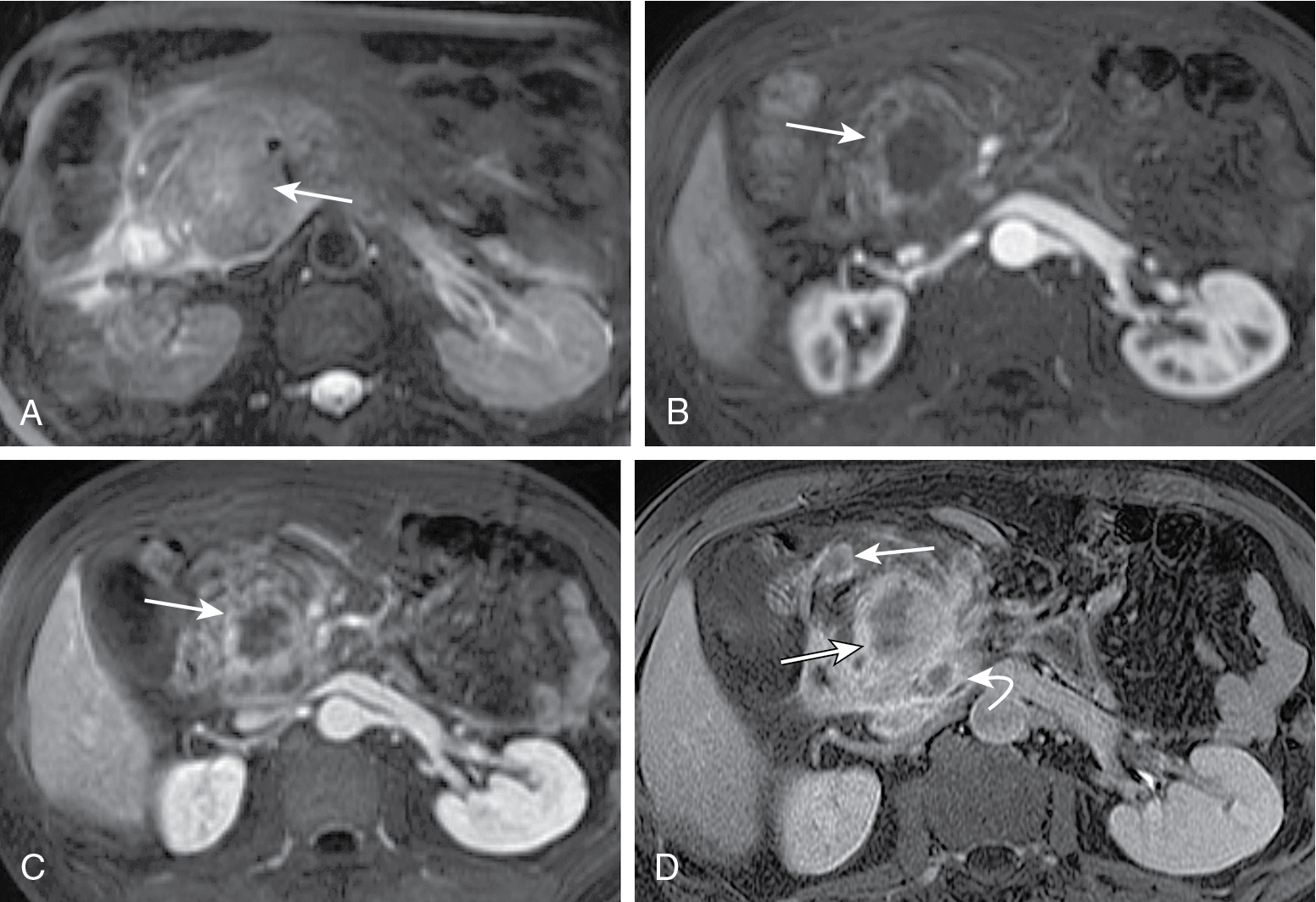 Fig. 13.7, Advanced pancreatic adenocarcinoma seen on T2-weighted (A) and pancreatic phase (B), portovenous phase (C), and late phase (D) contrast-enhanced T1-weighted magnetic resonance images as a heterogeneously hyperintense infiltrating lesion ( thin arrow ) on T2-weighted imaging and showing poor, heterogeneous, progressive contrast enhancement over time. Peritoneal metastases coexist ( long thin arrow , D), and necrotic lymph node metastases ( curved arrow , D) are also noted.