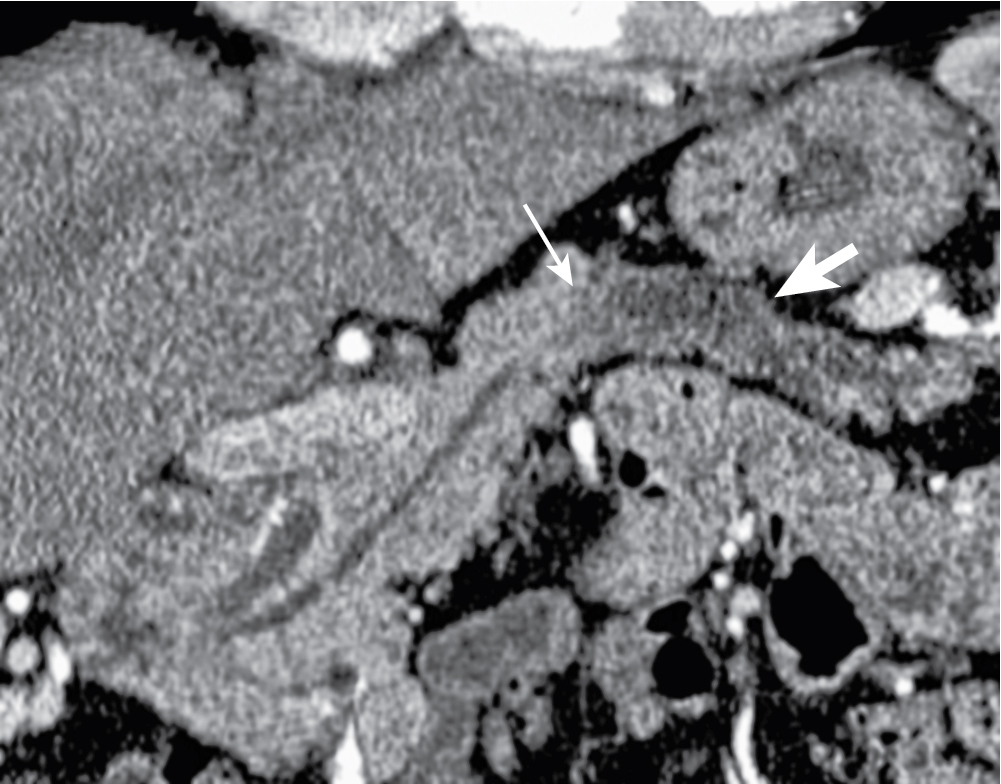 Fig. 13.8, Multidetector computed tomography–pancreatogram image showing abrupt obstruction of the main pancreatic duct with upstream dilatation ( thick arrow ) secondary to a small tumor ( thin arrow ).