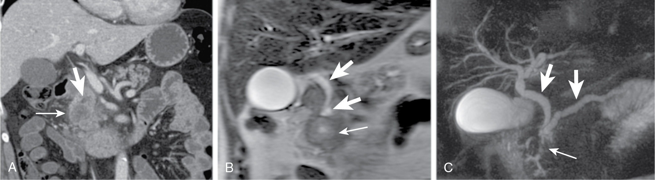 Fig. 13.9, Infiltrating pancreatic adenocarcinoma ( thin arrow ) causing obstruction and upstream dilatation of both the main pancreatic duct and the common bile duct ( thick arrows ) and showing the “double duct” sign on coronal multidetector computed tomography (A), coronal steady state fast spin echo T2-weighted (B) magnetic resonance image, and three-dimensional magnetic resonance cholangiopancreatography (C).