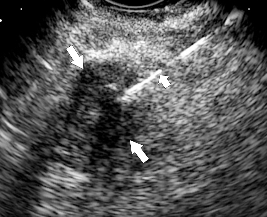 Fig. 13.10, Endoscopic ultrasound in a 65-year-old woman with an ill-defined 2-cm hypoechoic mass ( arrows ) in the head of the pancreas that proved to be ductal adenocarcinoma at biopsy ( small arrow ).