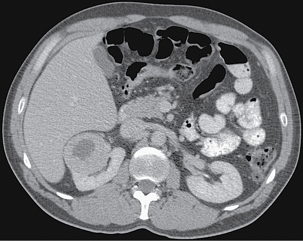 Fig. 24.1, Axial contrast-enhanced computed tomography in the nephrographic phase shows a solid enhancing mass with central low attenuation scar in the upper pole of the right kidney.