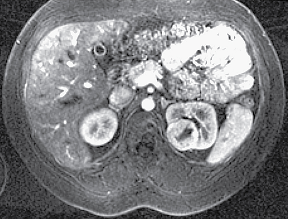 Fig. 24.2, T1-weighted postcontrast axial magnetic resonance image with fat suppression in the same patient as in Fig. 24.1 demonstrates enhancement of the left renal oncocytoma with no enhancement of the hypointense central scar.