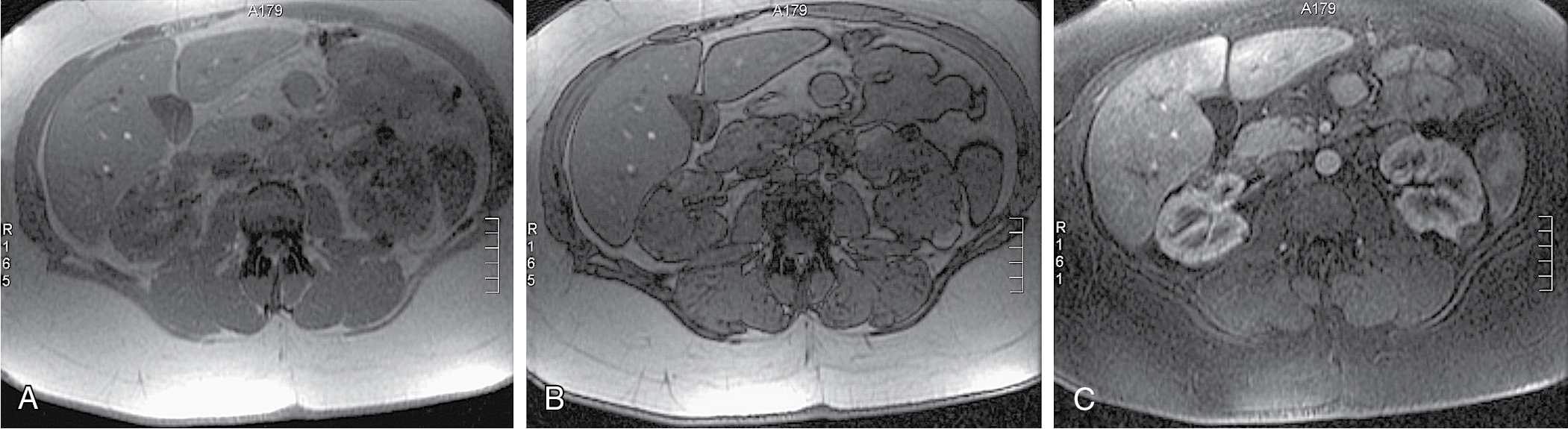 Fig. 24.4, In phase (A), opposed phase (B), and fat-suppressed (C) T1-weighted magnetic resonance imaging of the abdomen demonstrates a small exophytic mass along the posterior cortex of the left kidney. The mass shows type II chemical shift artifact (India ink artifact in B) and signal dropout on fat-suppressed imaging (C) because of the macroscopic fat present in this angiomyolipoma.