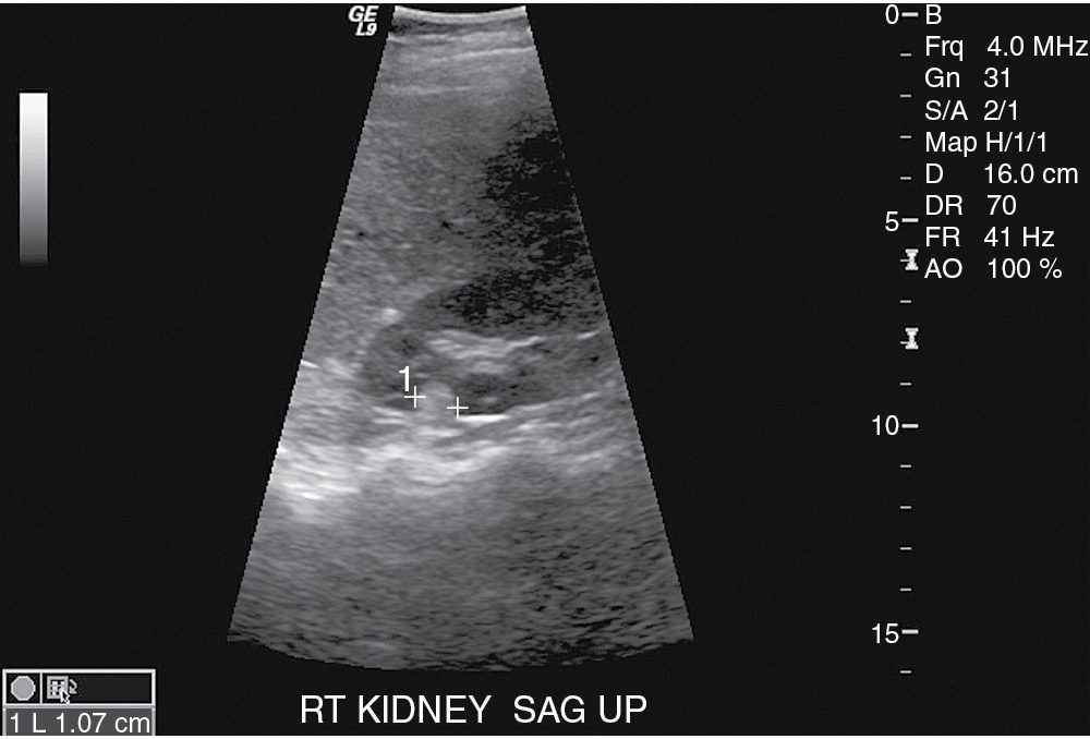 Fig. 24.5, Sagittal ultrasound of the right kidney shows a small well-circumscribed homogeneously hyperechoic solid renal mass, consistent with angiomyolipoma.