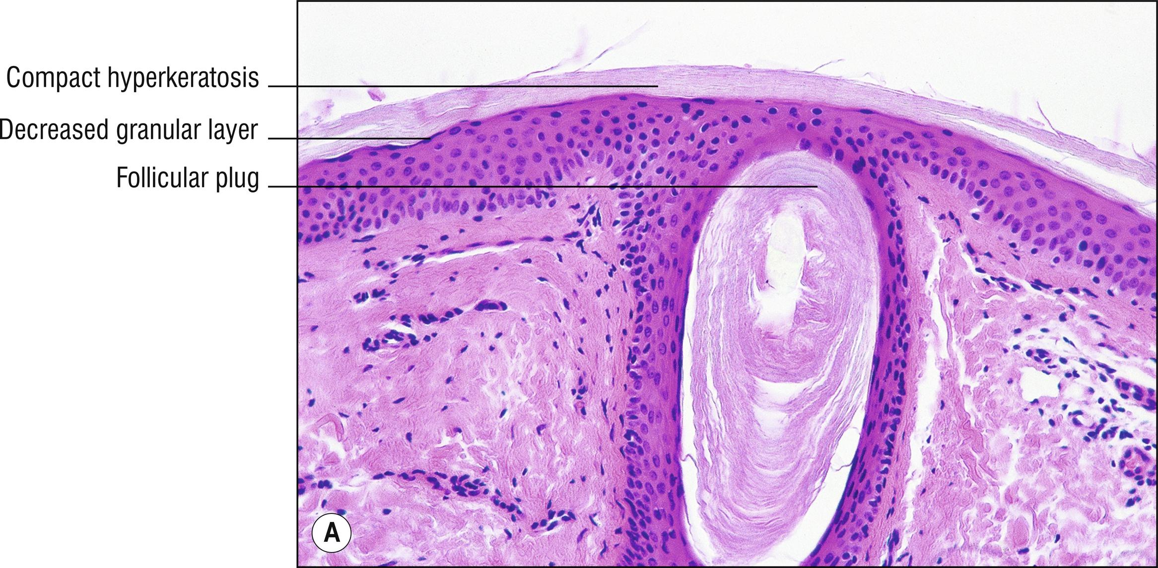 Fig. 11.1, A Ichthyosis vulgaris.