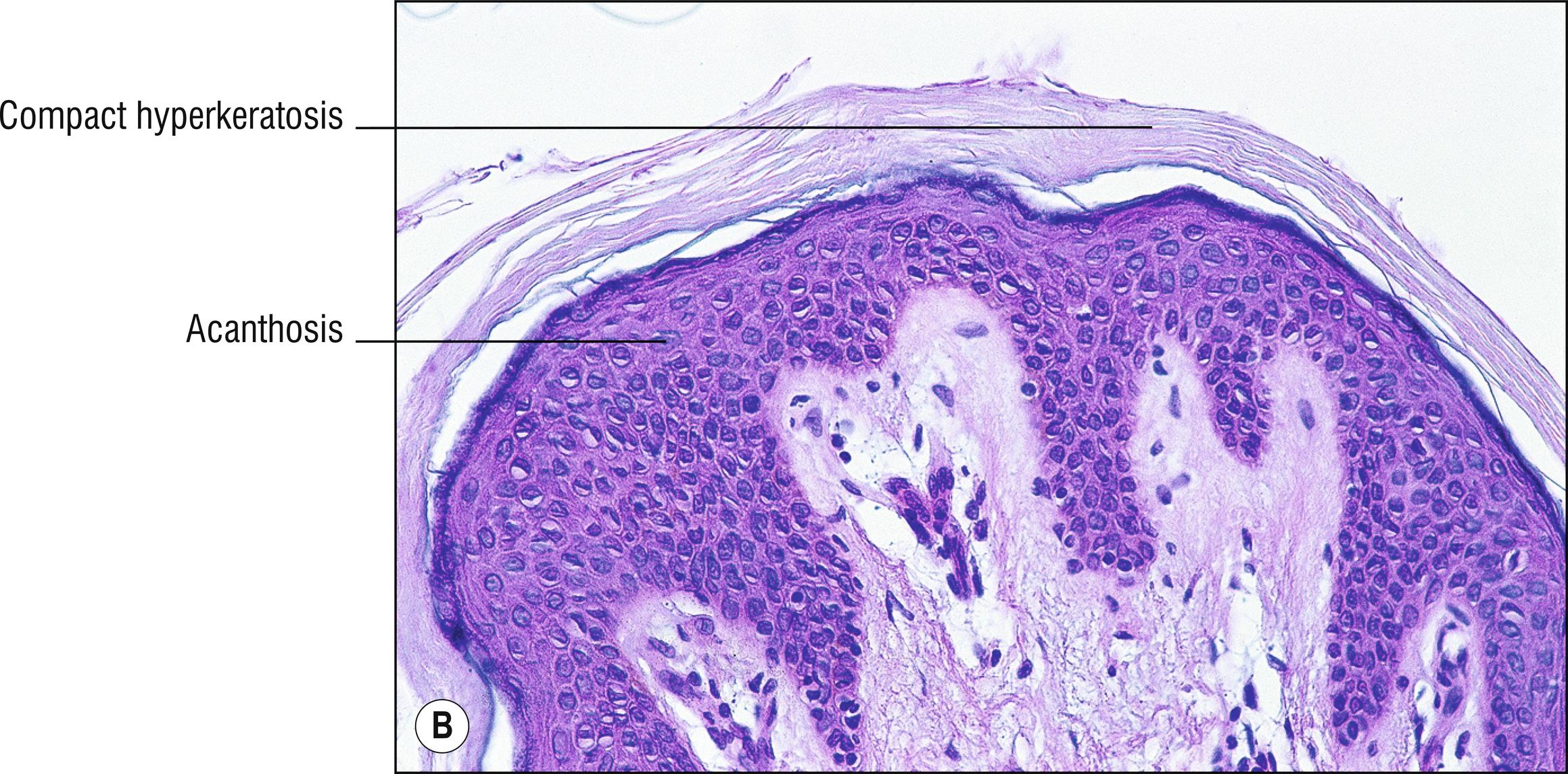 Fig. 11.1, B X-linked ichthyosis.