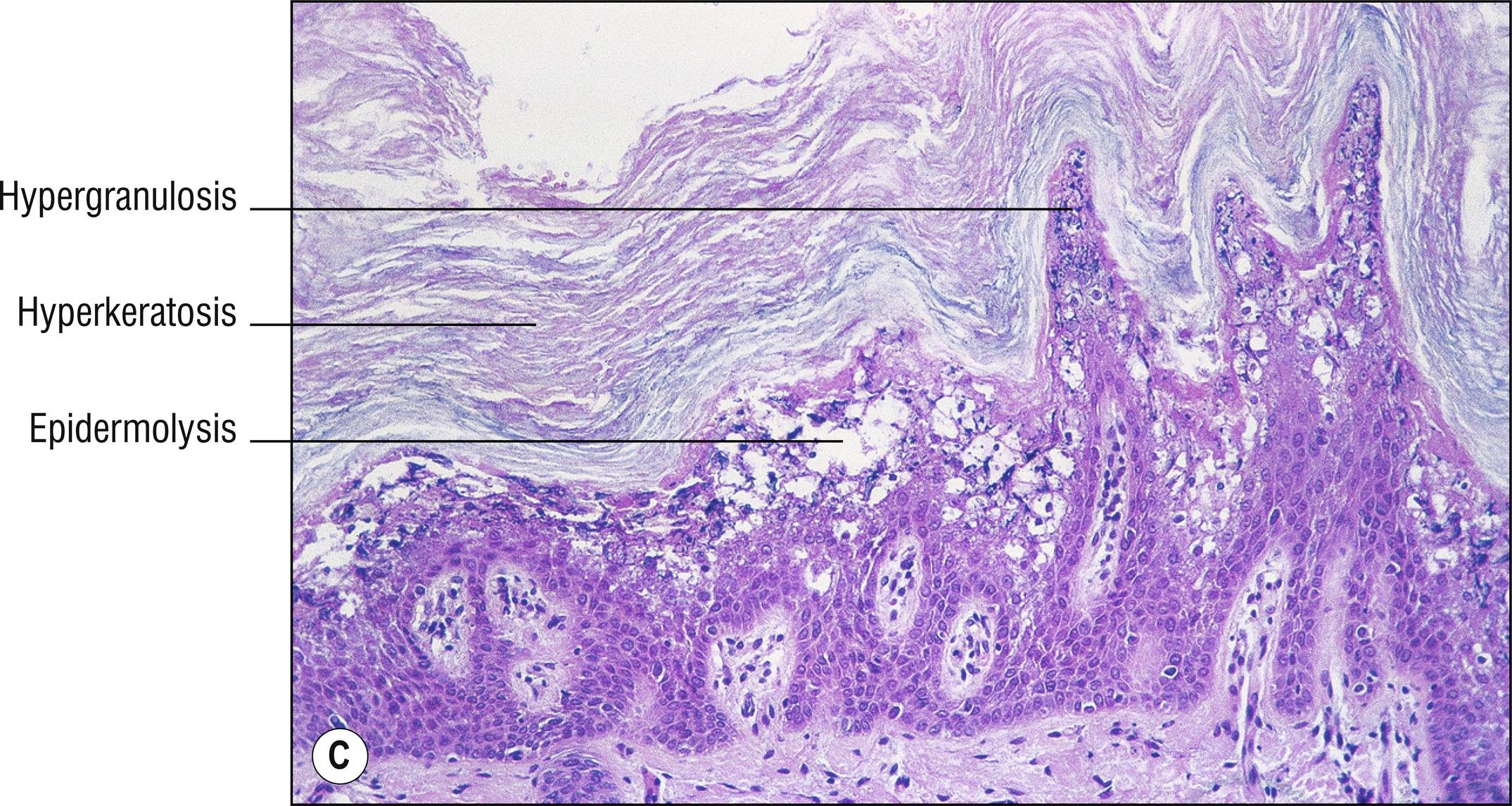 Fig. 11.1, C Epidermolytic hyperkeratosis.