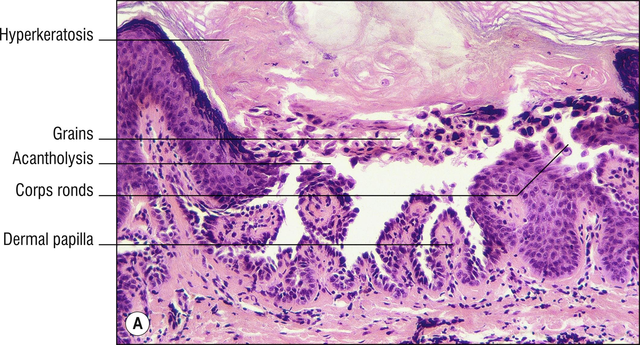 Fig. 11.3, A Darier’s disease (low mag.).