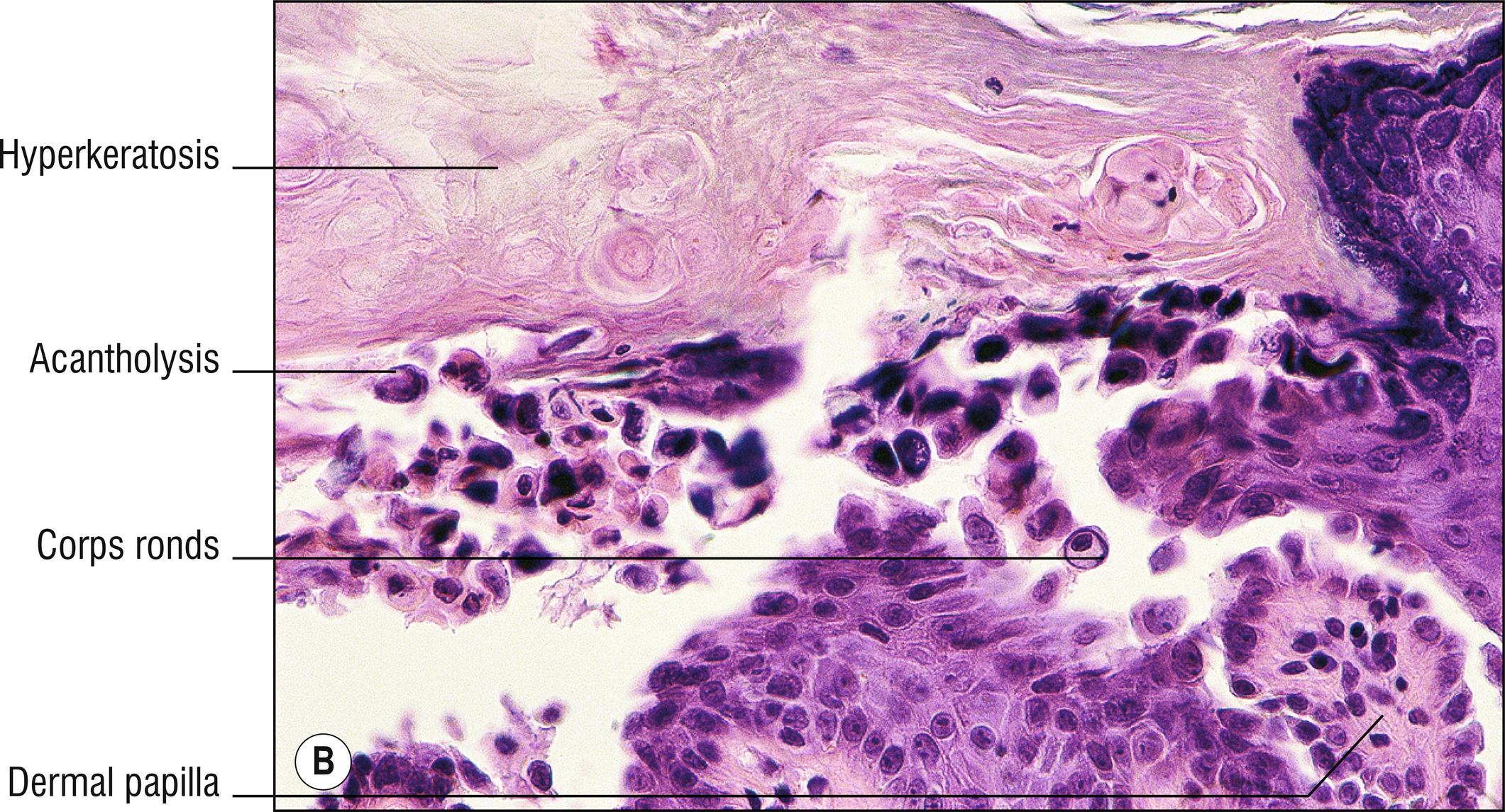 Fig. 11.3, B Darier’s disease (high mag.).