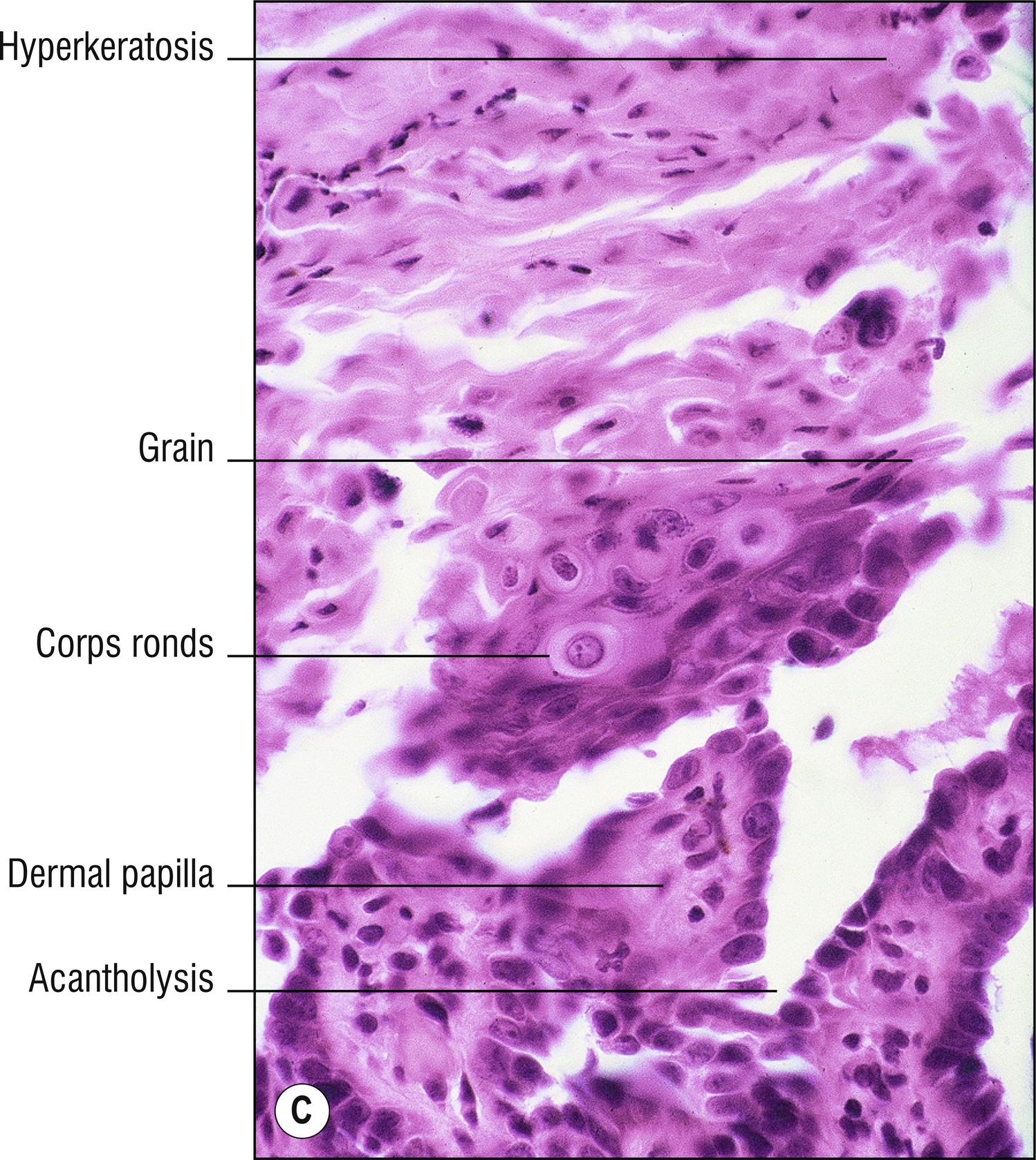 Fig. 11.3, C Darier’s disease (high mag.).