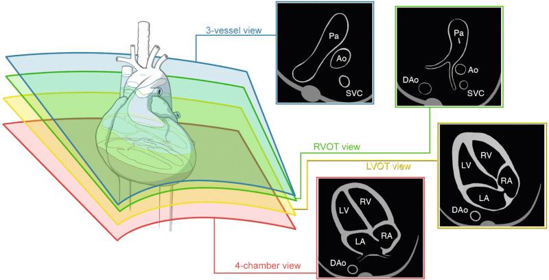 FIG 13-11, Sonographic scanning planes for fetal cardiac screening. The most inferior transverse plane is used to confirm that the stomach and heart are both on the left side of the fetus (not shown). A cephalad sweep of an ultrasound transducer toward the fetal head is used to visualize (1) four-chamber view; (2) left ventricular outflow tract (LVOT); (3) right ventricular outflow tract (RVOT); (4) and three-vessel view. Ao, ascending aorta; DAo, descending aorta; LA, left atrium; LV, left ventricle; Pa, pulmonary artery; RA, right atrium; RV, right ventricle; SVC, superior vena cava.