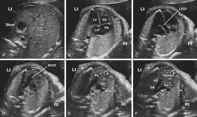 FIG 13-12, Standard ultrasound scanning planes are used to evaluate the fetal heart by evaluating the following: A, abdominal situs; B, four-chamber view; C, left ventricular outflow tract; D, right ventricular outflow tract; E, three-vessel view; and F, three-vessel and trachea view. Ao, ascending aorta; DA, ductus arteriosus; LA, left atrium; Lt, left; LV, left ventricle; LVOT, left ventricular outflow tract; Pa, pulmonary artery; PT, pulmonary artery trunk; RA, right atrium; Rt, right; RV, right ventricle; RVOT, right ventricular outflow tract; Sp, spine; Stom, stomach; SVC, right superior vena cava; Tr, trachea.