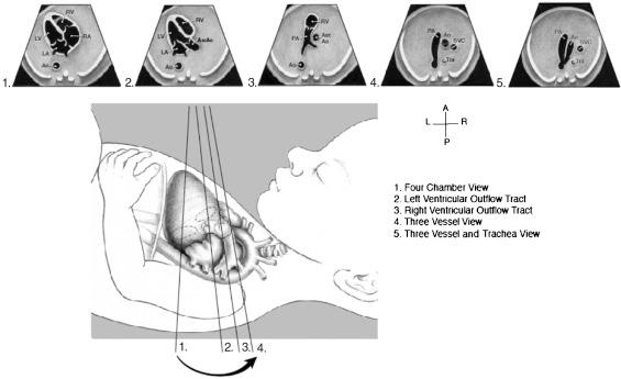 FIG 13-14, Standardized transverse scanning planes for fetal echocardiography include an evaluation of the four-chamber view (1), arterial outflow tracts (2 and 3), and the three-vessel and three-vessel and trachea views (4 and 5). A, anterior; Ao, descending aorta; Asc Ao, ascending aorta; L, left; LA, left atrium; LV, left ventricle; P, posterior; PA, pulmonary artery; R, right; RA, right atrium; RV, right ventricle; and Tra, trachea.