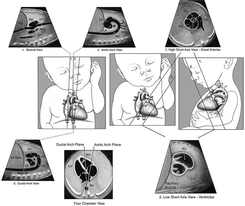 FIG 13-15, Sagittal views of the superior and inferior venae cavae, aortic arch, and ductal arch, as well as low and high short-axis views of the fetal heart. Ao, aorta; Ao Root, aortic root; DA, ductus arteriosus; Desc Ao, descending aorta; IVC, inferior vena cava; LA, left atrium; LV, left ventricle; PA: main pulmonary artery; PV, pulmonary valve; RA, right atrium; RPA, right pulmonary artery; RV, right ventricle; SVC, superior vena cava.