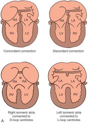 FIG 13-17, Biventricular atrioventricular connections ( A ), univentricular atrioventricular connections ( B ), and types of ventriculoarterial connections ( C ). Ao, ascending aorta; LA, left atrium; LV (lv), left ventricle; PA, main pulmonary artery; RA, right atrium; RV (rv), right ventricle; T, truncus.