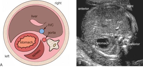 FIG 13-18, Transverse view of the upper abdomen, diagram ( A ) and sonographic image ( B ). The larger lobe of the liver is on the right, and the stomach on the left. The descending aorta is at the left anterior aspect of the spine. The inferior vena cava (IVC) is on the right side of the midline. Note that the IVC is located anteriorly at some distance from the spine as it courses forward to connect to the right atrium above this level.
