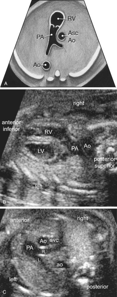 FIG 13-21, Diagram ( A ) and sonographic images ( B and C ) in the right ventricular outflow tract view and extended view including the branch pulmonary arteries. Ao, aorta; Asc Ao, ascending aorta; L, left pulmonary artery; LV, left ventricle; PA, main pulmonary artery; R, right pulmonary artery; RV, right ventricle; SVC, superior vena cava.