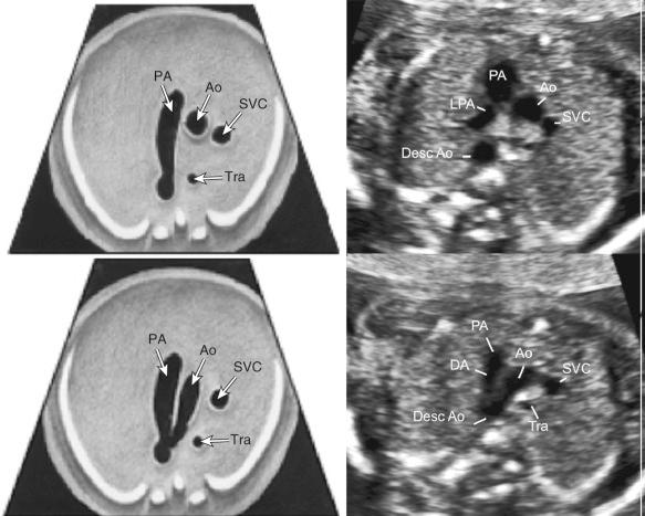 FIG 13-22, Diagrams ( left ) and sonographic images ( right ) in the three-vessel view (3VV) and three-vessel and trachea view (3VTV). The 3VTV plane is situated only a few millimeters more cephalad from the 3VV plane. The V-shaped connection between the aorta and ductus arteriosus is obtained by a slight counterclockwise rotation of the ultrasound transducer. Ao, ascending aorta; DA, ductal arch; Desc Ao, descending aorta; LPA, left pulmonary artery; PA, main pulmonary artery; SVC, superior vena cava; Tra, trachea.