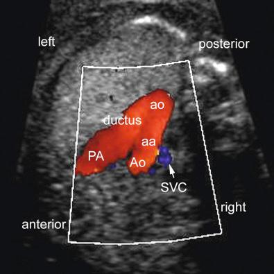 FIG 13-23, Three-vessel and trachea view using color Doppler imaging. aa, aortic arch; Ao, ascending aorta; ao, descending aorta; DA, ductal arch; PA, pulmonary artery; SVC, superior vena cava.