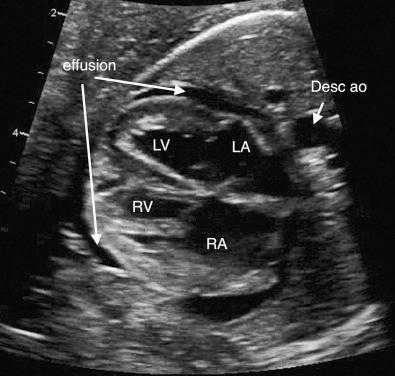 FIG 13-24, Circumferential pericardial effusion in the fetus. Desc ao, descending aorta; LA, left atrium; LV, left ventricle; RA, right atrium; RV, right ventricle.