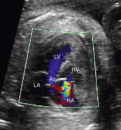 FIG 13-25, Moderate to severe tricuspid valve regurgitation. Ao, aorta; LA, left atrium; LV, left ventricle; RA, right atrium; RV, right ventricle.