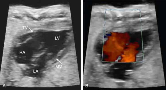 FIG 13-26, Double-inlet left ventricle (LV) by two-dimensional imaging ( A ) and color Doppler imaging ( B ). Both the tricuspid valve (TV) and the mitral valve (MV) open into the LV. The right ventricle is severely hypoplastic and not visible from this view. LA, left atrium; RA, right atrium.