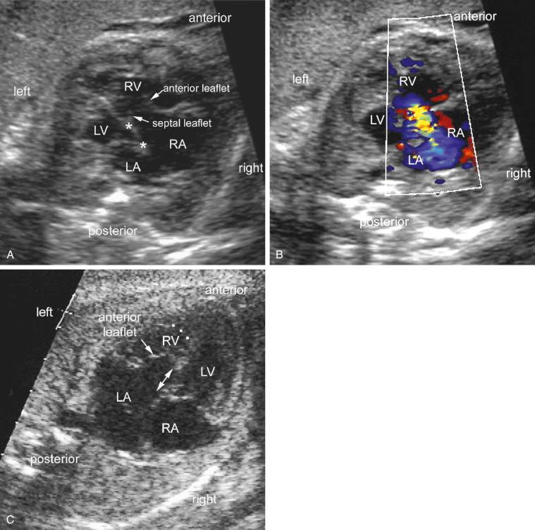 FIG 13-27, Ebstein malformation of the tricuspid valve. A, Four-chamber view shows a big heart with dilatation of the right atrium (RA) and right ventricle (RV). Note the displaced attachment of the septal leaflet of the tricuspid valve ( upper asterisk ). The anterior leaflet of the mitral valve has a normal insertion to the septum ( lower asterisk ). The anterior leaflet of the tricuspid valve is large, whereas the septal leaflet is small. B, Color Doppler image in the same view as A shows moderate tricuspid regurgitation. C, Ebstein malformation in a patient with congenitally corrected transposition of the great arteries (atrioventricular discordance with ventriculoarterial discordance). LA, left atrium; LV, left ventricle.
