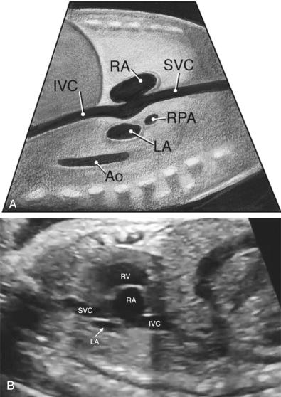 FIG 13-28, Diagram ( A ) and sonographic image ( B ) in the bicaval view. The atrial septum and foramen ovale are best seen from this view as well between the left atrium (LA) and right atrium (RA). Ao, descending aorta; IVC, inferior vena cava; RPA, right pulmonary artery; RV, right ventricle; SVC, superior vena cava.