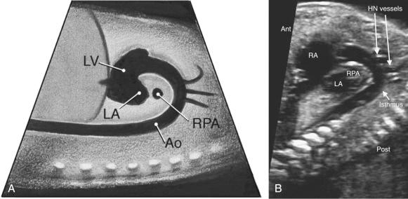 FIG 13-29, Diagram ( A ) and sonographic image ( B ) in the long axis of the aortic arch. In addition to the arch and the head and neck (HN) vessels, the right atrium (RA), left atrium (LA), and atrial septum can often be seen in this view. Ant, anterior; Ao, aorta; LV, left ventricle; Post, posterior; RPA, right pulmonary artery.