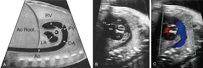 FIG 13-30, Diagram ( A ) and sonographic images ( B and C ) in the long axis of the ductal arch by two-dimensional and color Doppler imaging. Ao, aorta; Ao Root, aortic root; DA, ductal arch; LA, left atrium; PV, pulmonary valve; RA, right atrium; RPA, right pulmonary artery; RV, right ventricle; TV, tricuspid valve.