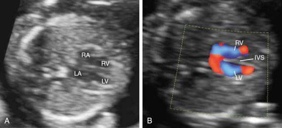 FIG 13-3, Early gestation four-chamber view. A, Four-chamber view in a fetus at weeks of gestation. B, Four-chamber view with high definition color Doppler in a fetus at weeks of gestation. Note that color Doppler allows for a better delineation of the interventricular septum. IVS, interventricular septum; LA, left atrium; LV, left ventricle; RA, right atrium; RV, right ventricle.