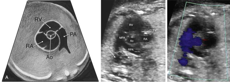 FIG 13-31, Diagram ( A ) and sonographic images ( B and C ) in the high short-axis view of the great arteries by two-dimensional and color Doppler imaging. Ant, anterior; Ao: aortic root; Desc ao, descending aorta; LPA, left pulmonary artery; MPA, main pulmonary artery; PA, main pulmonary artery; Post, posterior; RA, right atrium; RPA, right pulmonary artery; RV, right ventricle; Tr, trachea; TV, tricuspid valve.