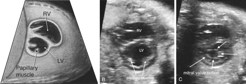 FIG 13-32, Diagram (A) and sonographic images (B and C) in the low short-axis view of the ventricles. At the midventricular level two papillary muscles are seen in the left ventricle. Just basal to this (closer to the atria), the mitral valve can be visualized en face to ensure there is not a cleft and that there is not a common atrioventricular valve. LV, left ventricle; RV, right ventricle.