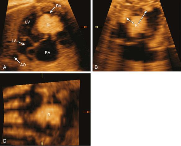 FIG 13-36, Multiplanar display of a fetus with cardiac rhabdomyomas allowing the simultaneous visualization of a large cardiac tumor in the four-chamber view ( A ) filling most of the right ventricle (RV), whereas the sagittal ( B ) and coronal ( C ) planes reveal additional smaller tumors that are not seen in the axial plane. AO, aorta; LA, left atrium; LV, left ventricle; R, rhabdomyoma; RA, right atrium.