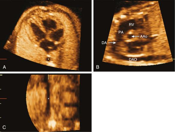 FIG 13-38, Multiplanar display of a normal fetal heart in the second trimester of pregnancy. A, The four-chamber view. B, The components of the sagittal view of the ductal arch including the right ventricular (RV) outlet, main pulmonary artery (PA), ductus arteriosus (DA), descending aorta (DAO), and a cross section of the ascending aorta (AAo). C, The coronal view of the DAO.