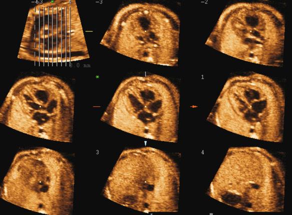 FIG 13-39, Tomographic ultrasound imaging: an overview image is shown in the upper left corner; the parallel lines in the overview image demarcate the position of the slices within the volume dataset.