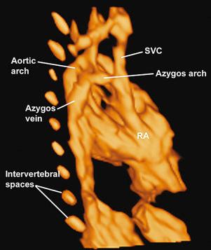 FIG 13-40, Three-dimensional reconstruction of a fetal heart rendered with the inversion mode in a case of interrupted inferior vena cava with azygous vein continuation. RA, right atrium; SVC, superior vena cava.