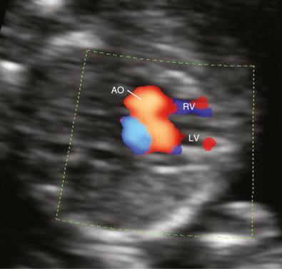 FIG 13-4, Color Doppler imaging demonstrates a five-chamber view in the first trimester of pregnancy; the aortic root is visualized arising from the left ventricle. AO, aorta; LV, left ventricle; RV, right ventricle.