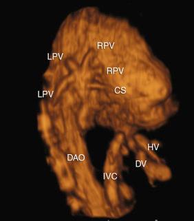 FIG 13-41, B-flow imaging of a fetus with total anomalous pulmonary venous return. The confluence of pulmonary vein, behind the right atrium and above the coronary sinus, resembles a starfish; CS, coronary sinus; DAO, descending aorta; DV, ductus venosus; HV, hepatic vein; IVC, inferior vena cava; LPV, left pulmonary vein; RPV, right pulmonary vein.