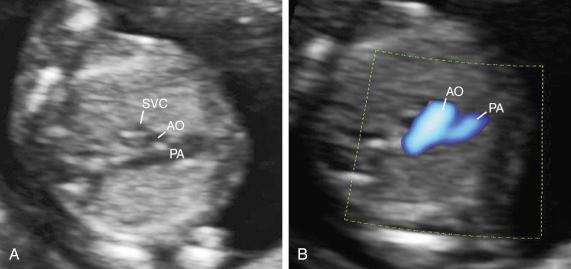 FIG 13-5, The three-vessel and trachea view demonstrates the main pulmonary artery in communication with the ductus arteriosus ( A ). Color flow mapping is useful in the delineating the great arteries and the confluence of the ductus arteriosus and the aortic arch (V sign) ( B ). AO, aorta; PA, pulmonary artery; SVC, superior vena cava.