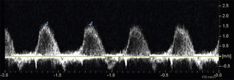 FIG 13-6, Spectral Doppler in a first trimester fetus with severe tricuspid valve regurgitation. Note that the duration of regurgitation extends for over half of systole.